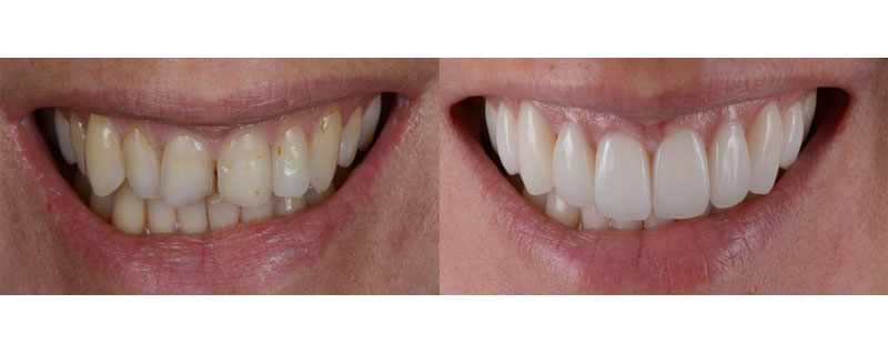Teeth Laminate treatment in Bandra & Chembur